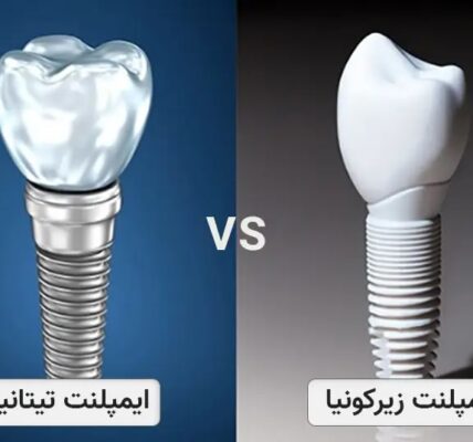 ایمپلنت تیتانیومی برای شما مناسب تر است یا ایمپلنت زیرکونیا؟