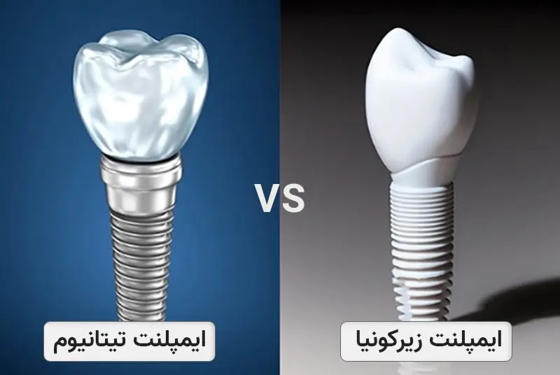ایمپلنت تیتانیومی برای شما مناسب تر است یا ایمپلنت زیرکونیا؟