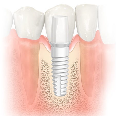 ایمپلنت تیتانیومی برای شما مناسب تر است یا ایمپلنت زیرکونیا؟2
