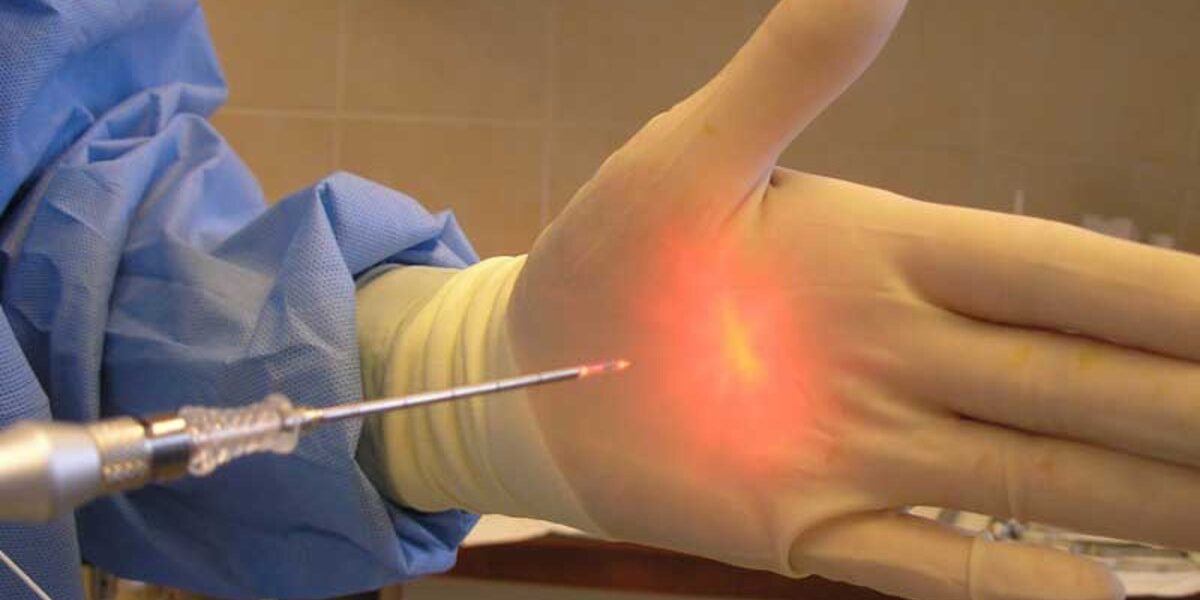 لیزر هموروئید؛ درمانی قطعی و فوری