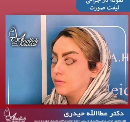 کارهایی که بعد از لیفت صورت ممنوع است !