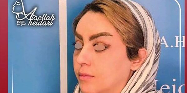 کارهایی که بعد از لیفت صورت ممنوع است !