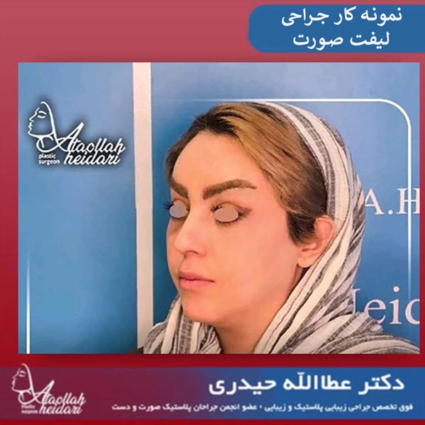 کارهایی که بعد از لیفت صورت ممنوع است !