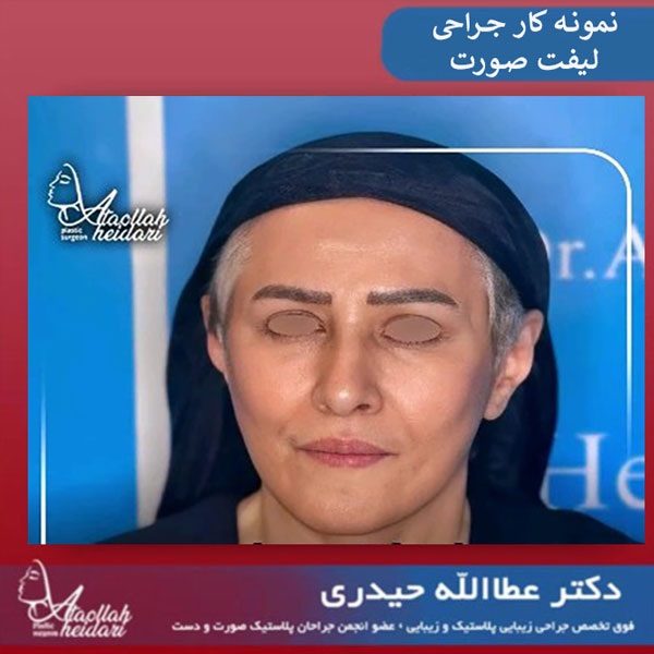 کارهایی که بعد از لیفت صورت ممنوع است !3